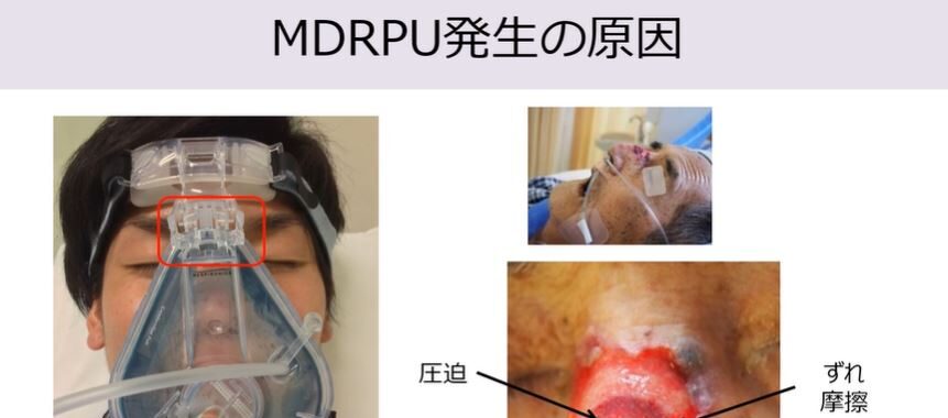 NPPV用マスクの医療関連機器圧迫創傷（MDRPU）対策
